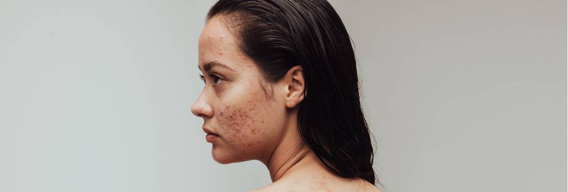 A minha acne pode desaparecer naturalmente?