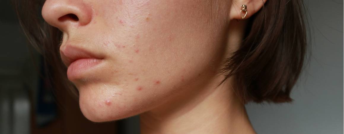 A acne significa que tem um sistema imunitário fraco?