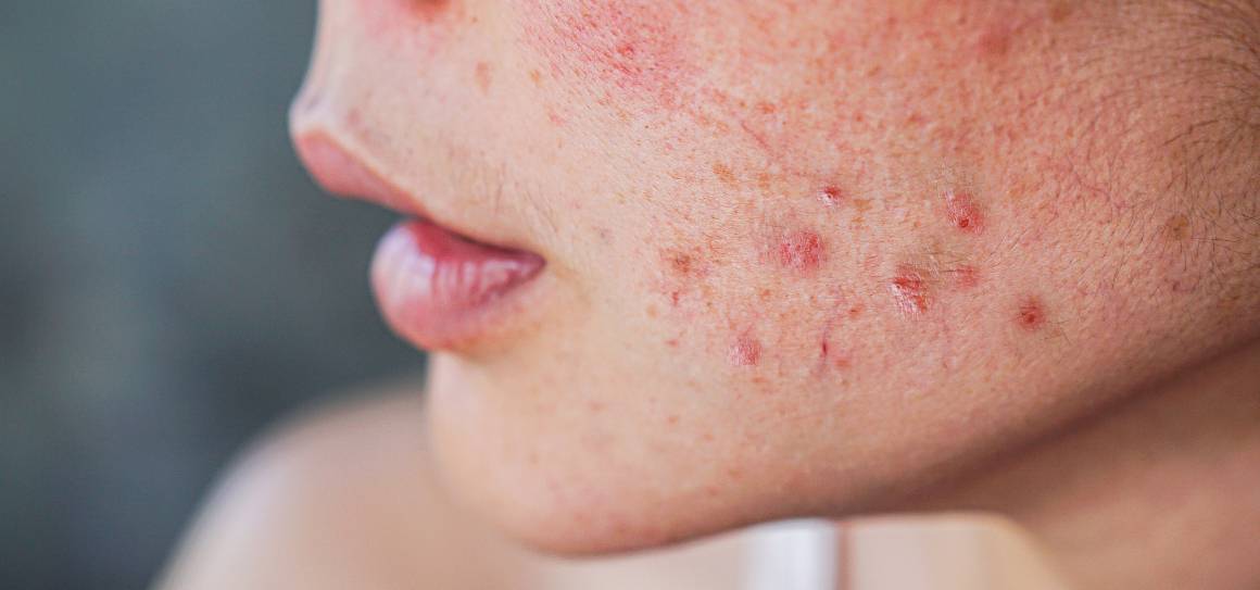 Como é que os dermatologistas se livram da acne?