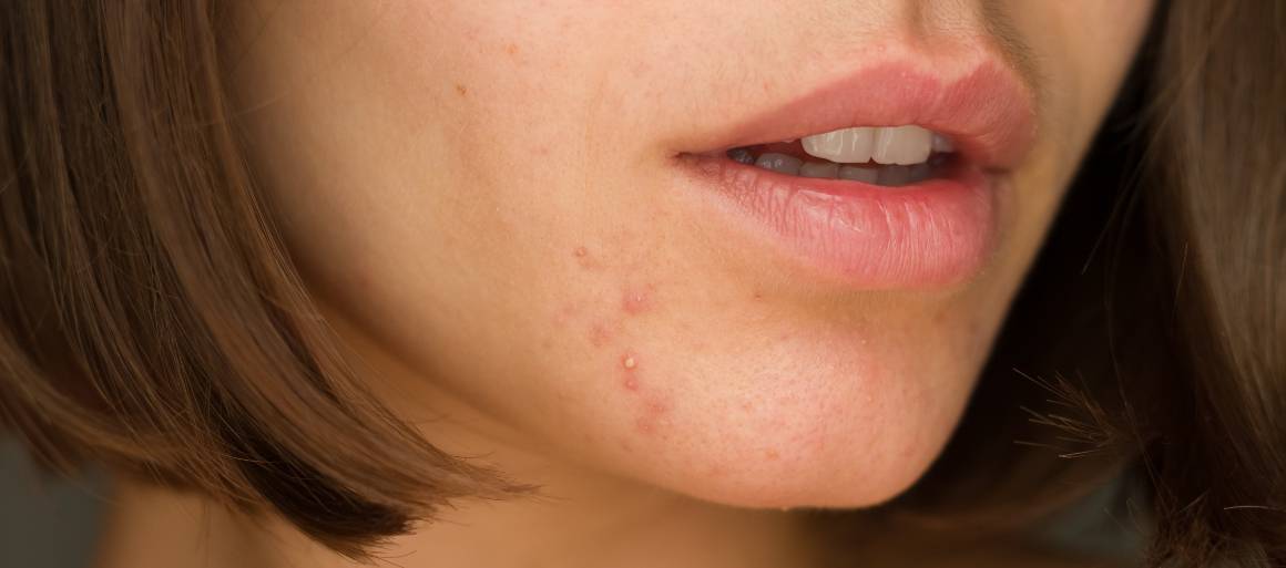Que alimentos ajudam a combater a acne?