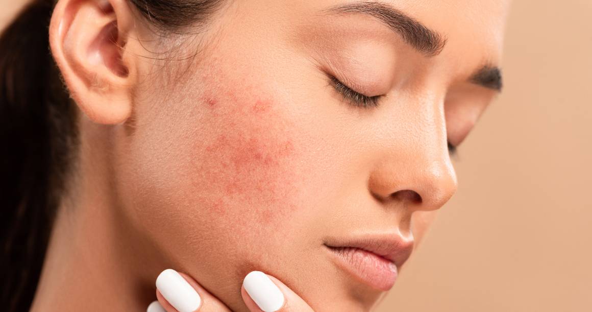 O que mata as bactérias do acne