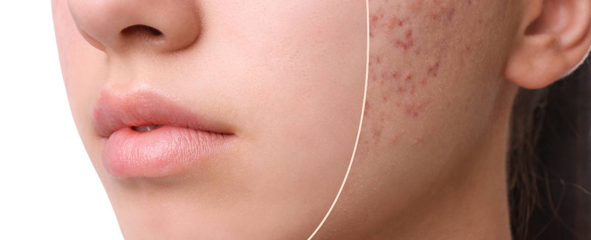 Qual é a diferença entre acne e borbulhas?