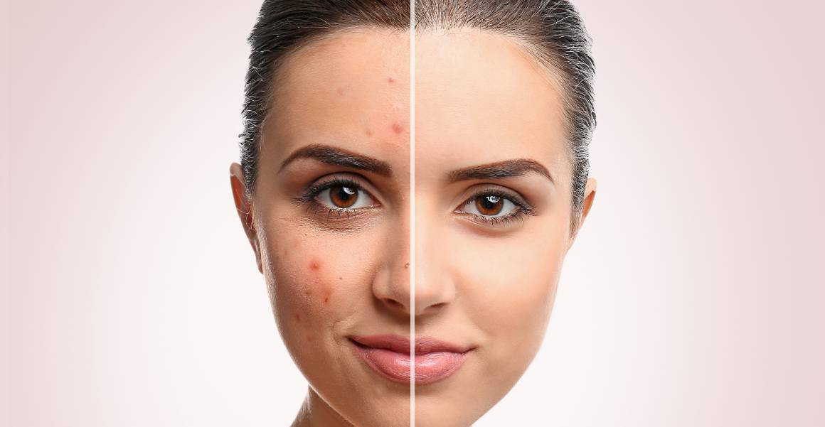 Qual é a principal causa da acne?