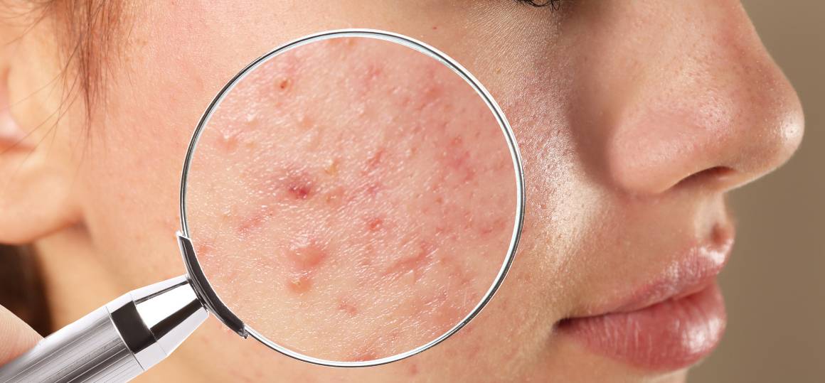 Porque é que é tão difícil livrar-se da acne?