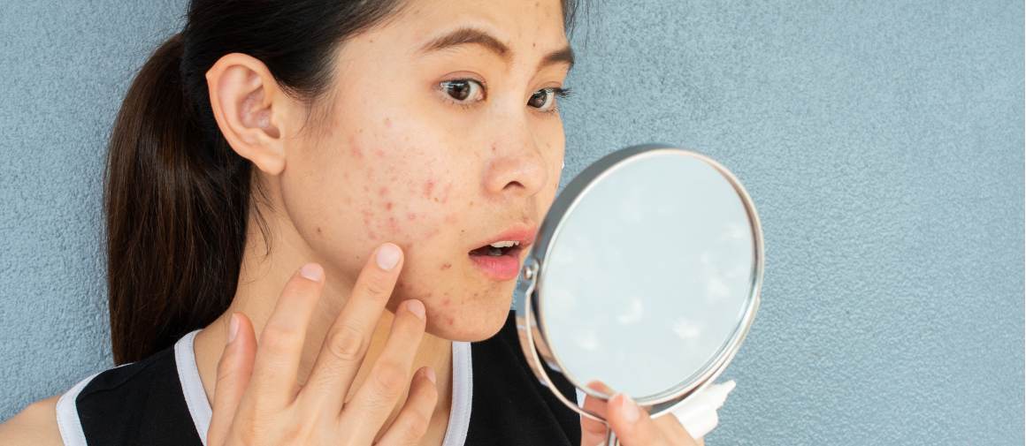 A minha acne é causada pela ansiedade?