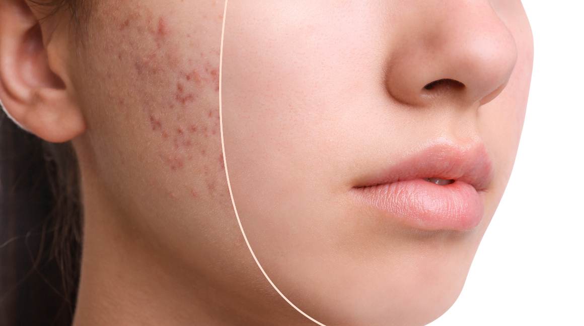 Quais são as 5 causas da acne?