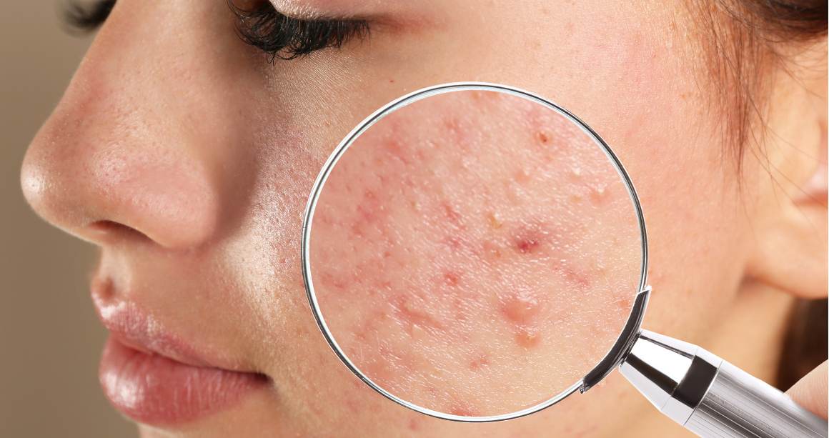Qual é a diferença entre borbulhas e acne?