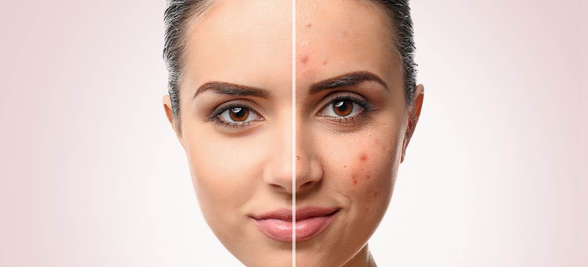 Como posso saber que tipo de acne tenho?