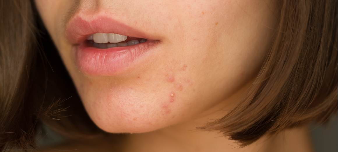 O que causa a acne no queixo