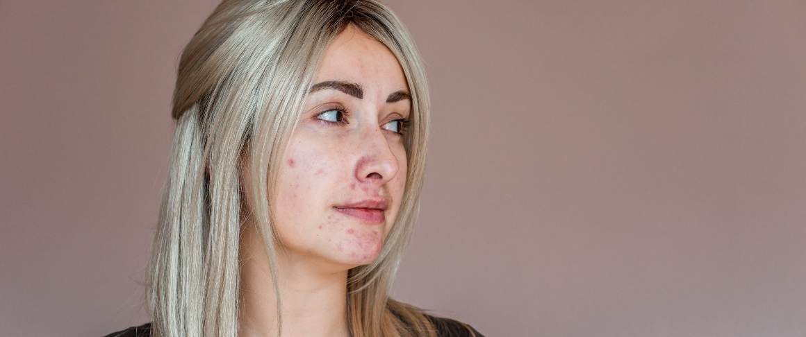 Que alimentos curam a acne?