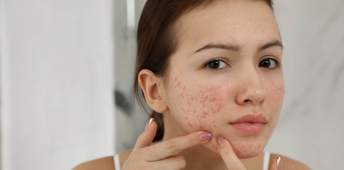 Que hormona causa acne nas mulheres?