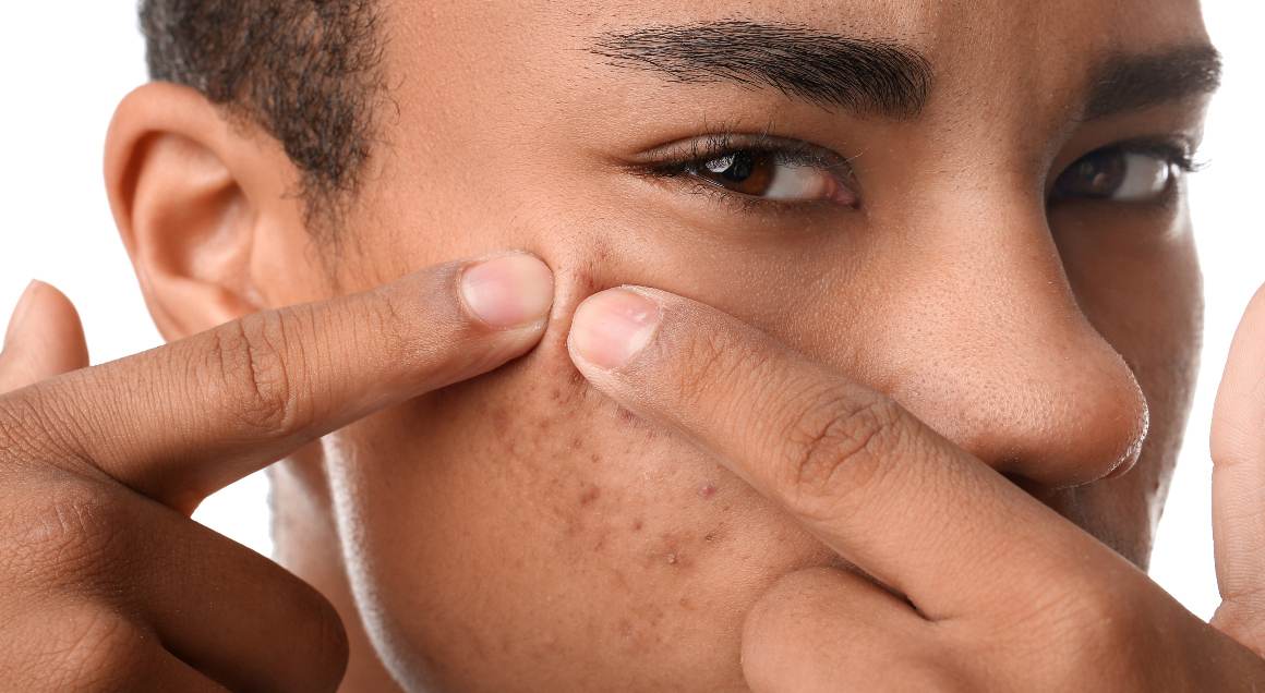 Quais são os 2 tipos mais comuns de acne?