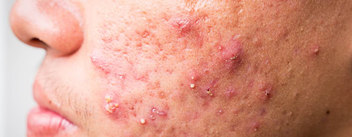 Quais são as últimas fases da acne?