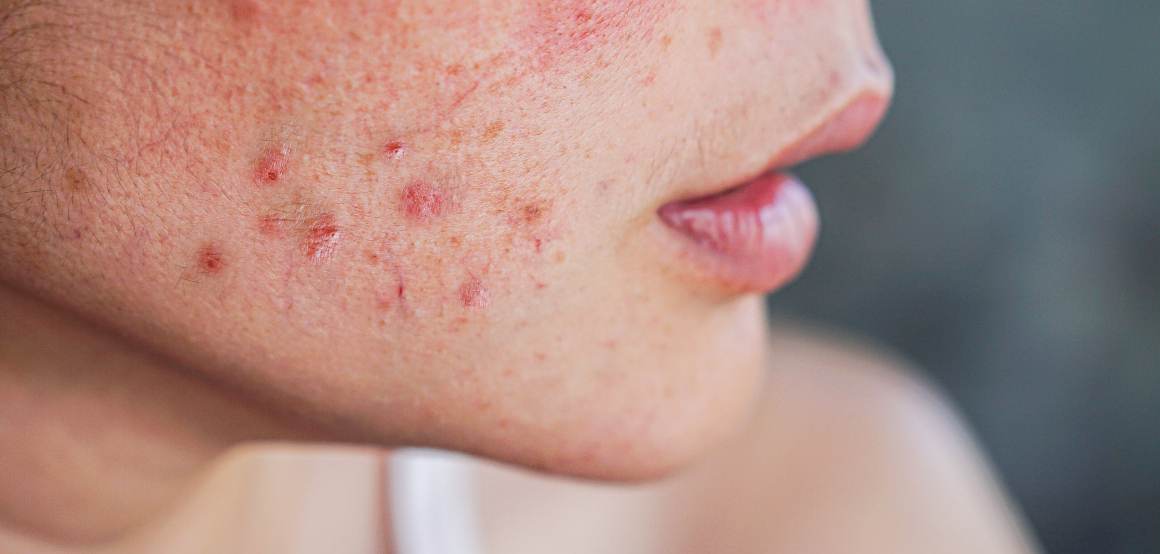 Porque é que a minha acne está a piorar?