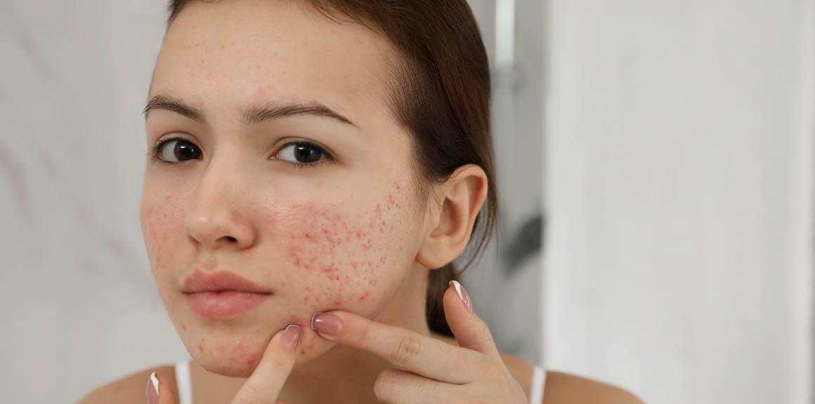 O álcool causa acne?