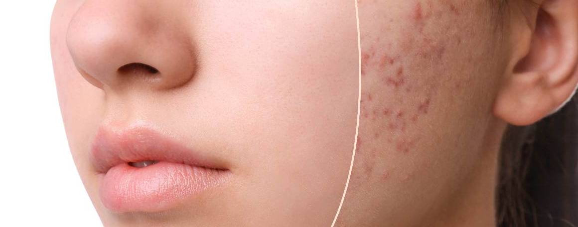 A falta de sono causa acne?