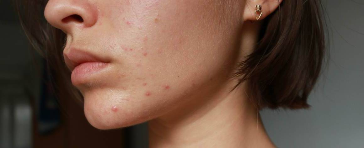 Como posso saber se o meu acne é hormonal ou de stress?