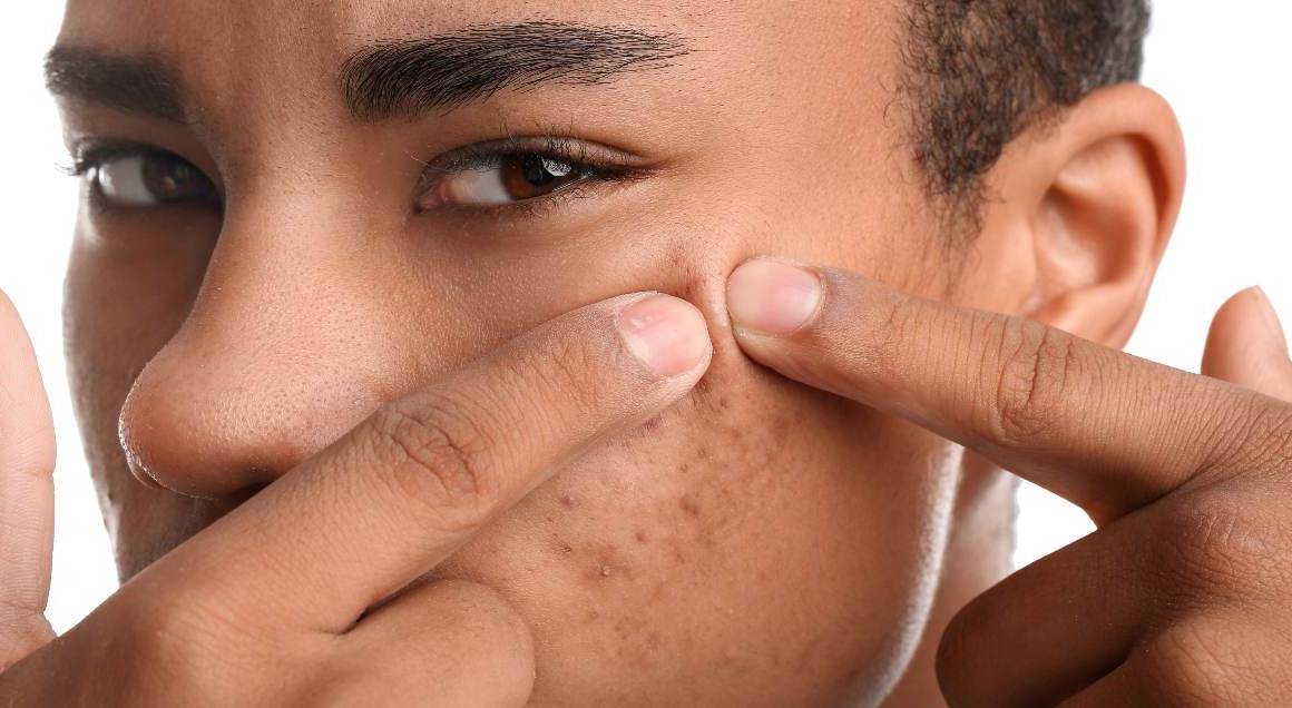 O que desencadeia a acne cística
