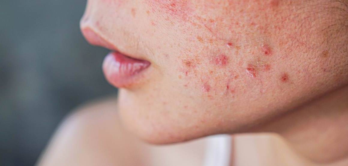 Porque é que, de repente, estou a ficar com acne grave