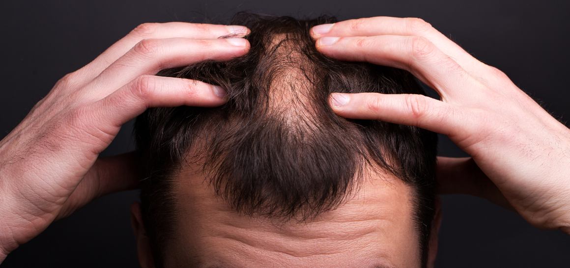O óleo CBD pode ajudar o seu cabelo a crescer?