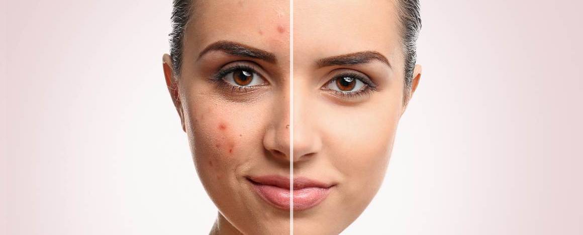 Lavar o rosto piora a acne