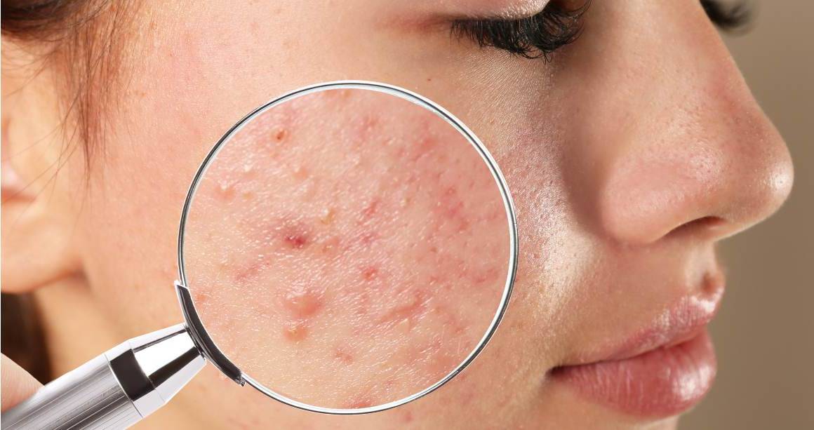 Quanto tempo é necessário para limpar completamente a acne?