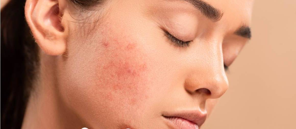 O que é que os dermatologistas receitam normalmente para a acne