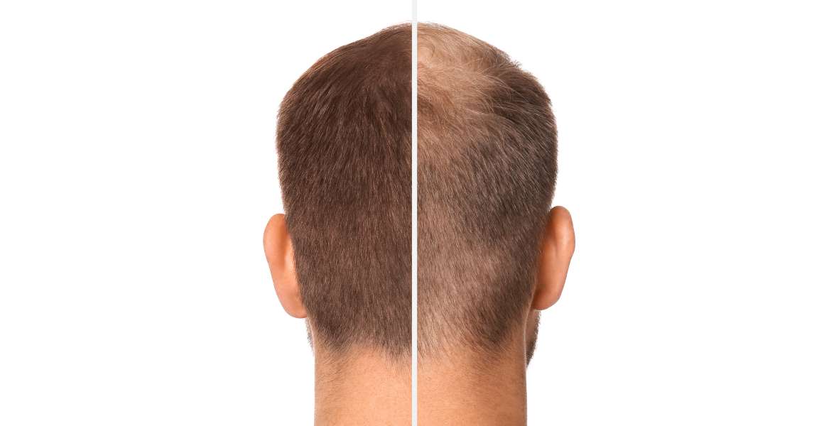 O ómega 3 ajuda no crescimento do cabelo?