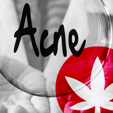 How Can CBD Help In The Fight Against Acne?