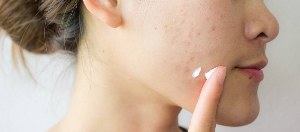 Como é que posso prevenir a acne naturalmente?