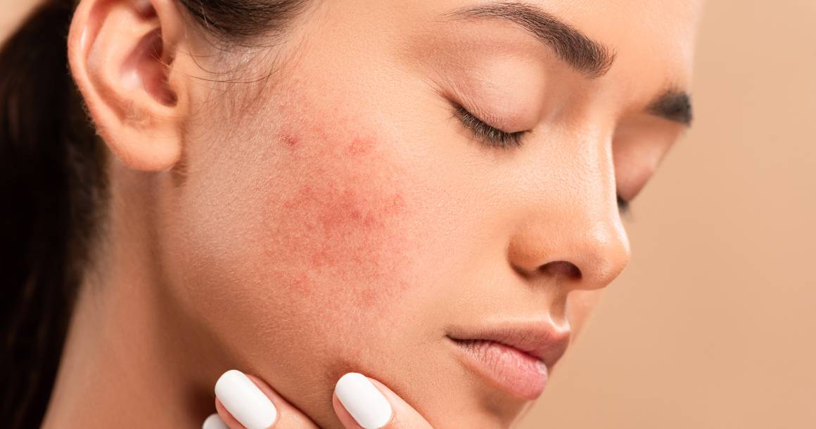 O que mata as bactérias do acne?