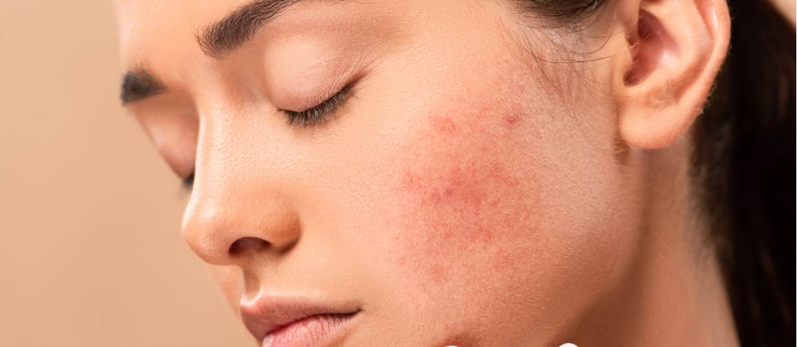 Que tipo de acne é mais difícil de tratar?
