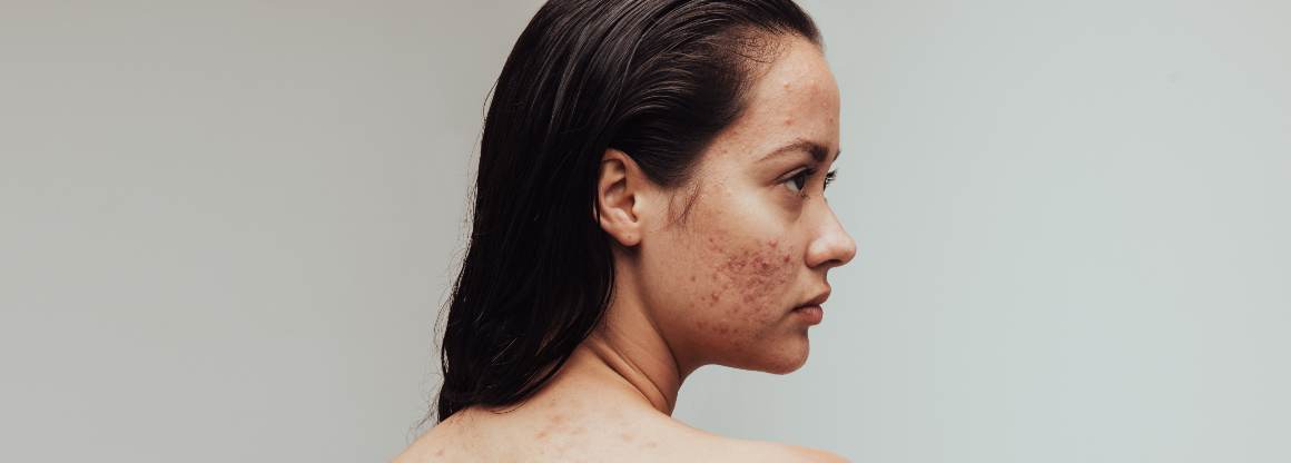 Que alimentos causam acne? Os 9 principais alimentos que provocam acne