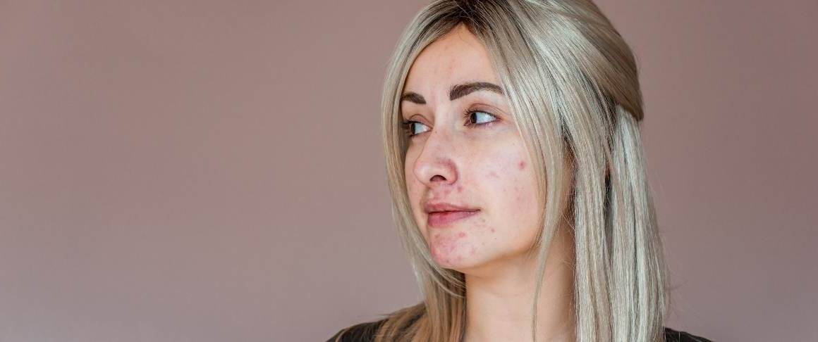 O que significa a acne nas bochechas?