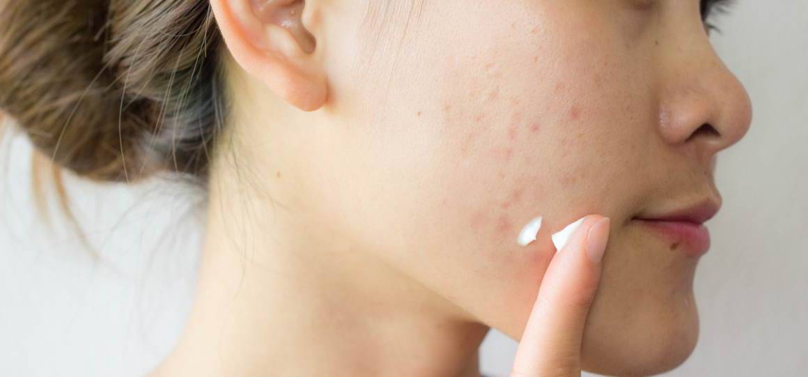 O açúcar provoca acne?