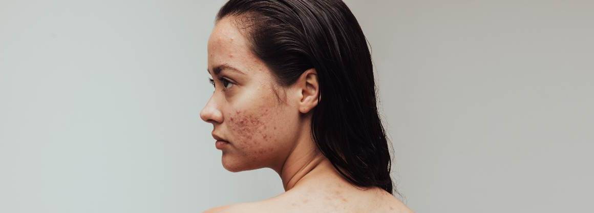 A desidratação pode causar acne?