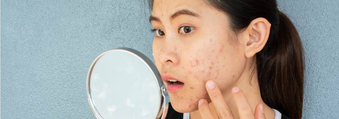 Em que idade é que a acne é pior?