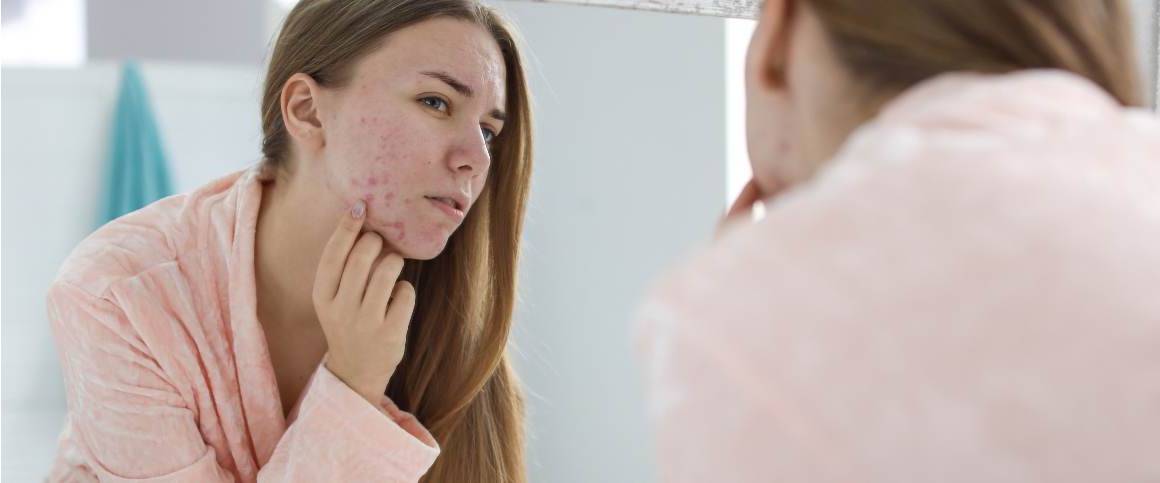 A acne regressa depois da doxiciclina?